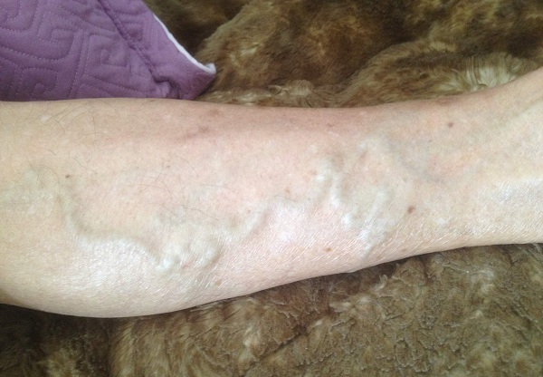 (2)小腿有青筋多是静脉曲张,此病严重者往往发生腰腿疾病,风湿关节痛.